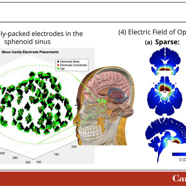 Optimized Transnasal Electrical Stimulation Using High-Density Electrode Arrangements